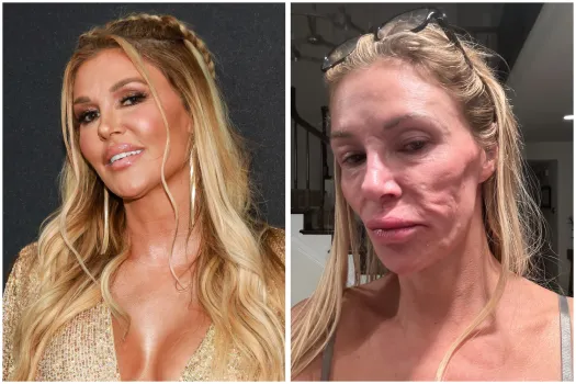 Reality Star Brandi Glanville Shares Shocking Photo of Her Swollen Face and Details Struggles with Unidentified Health Issue in Beverly Hills