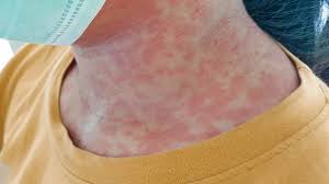 Scientists Reveal Skin Rash Could Be an Early Warning Sign of HMPV Infection Spreading in the UK and US