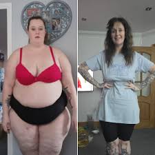 Crystal Rudd Overcomes Childhood Food Addiction to Lose 11 Stone After Gastric Sleeve Surgery in Istanbul, Turkey, and Removes Excess Skin