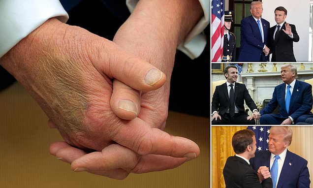 Donald Trump’s Mysterious Hand Bruise Sparks Health Concerns as Awkward Handshake with Emmanuel Macron at the White House Goes Viral