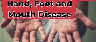 NICD Assures Public That Hand, Foot and Mouth Disease Outbreak in KwaNICD Assures Public That Hand, Foot and Mouth Disease Outbreak in KwaZulu-Natal is Under Control and No Need to PanicZulu-Natal is Under Control and No Need to Panic