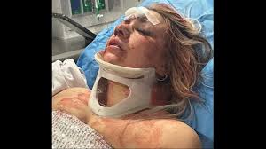 A Dallas Woman Born with a Rare Genetic Condition Faces Devastating New Facial Injuries After Being Brutally Attacked by Her Ex-Boyfriend