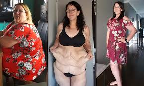 Brenda Langford overcomes childhood bullying and food addiction to reclaim her health through life-changing weight loss surgery in Australia
