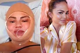 Chrissy Teigen Shares Hospital Photo Revealing Hairline Lowering Procedure After Experiencing Hair Loss Following Motherhood