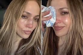Jennifer Lopez reveals arm bruise and shares healing update from face injury during intense AMAs rehearsals in Las Vegas