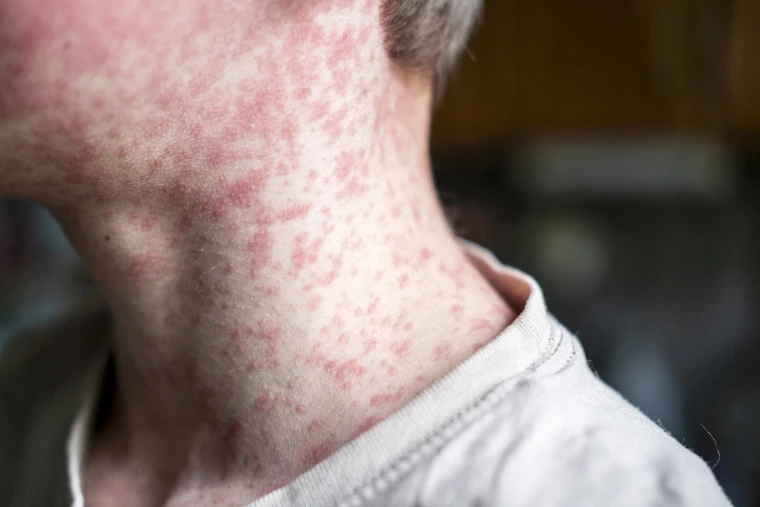Health experts reveal Texas is now the center of the worst measles outbreak in 30 years as low vaccination rates trigger widespread infections