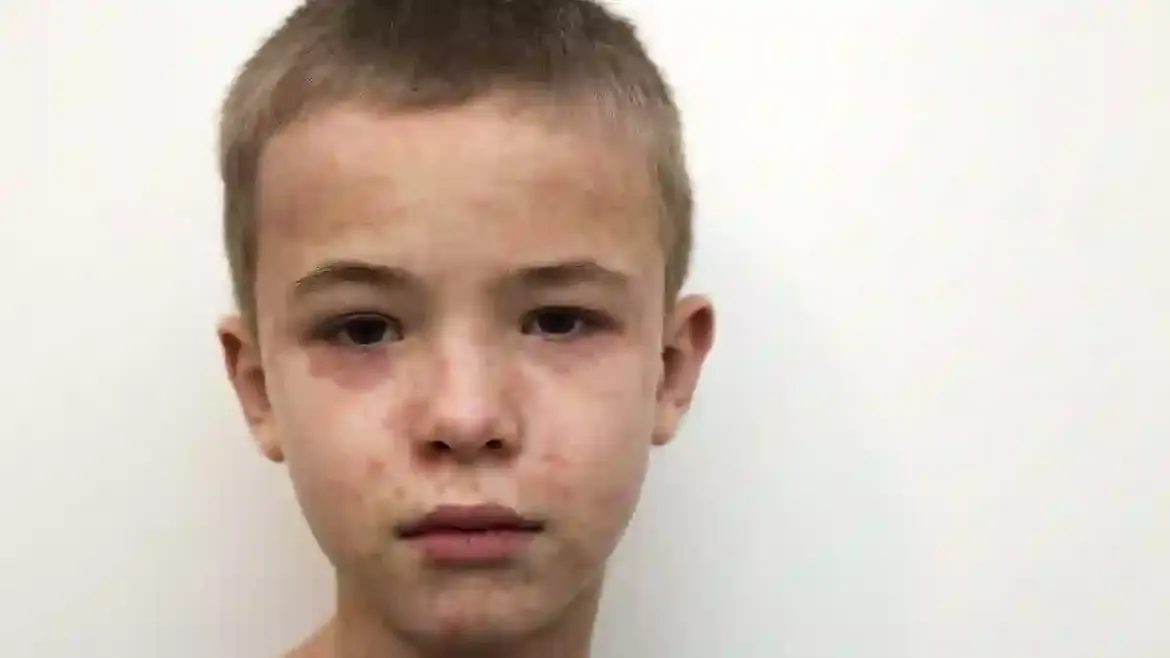 Unvaccinated traveler from Illinois visits St Louis Aquarium and potentially exposes hundreds to measles in Missouri