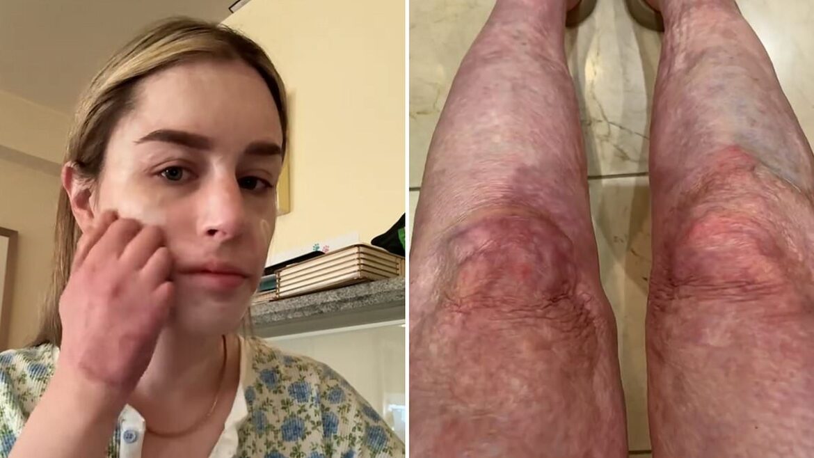 Burns survivor Stephanie Browitt details her physical therapy and skincare routine five years after tragic volcanic explosion on White Island in New Zealand