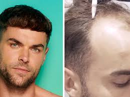 Love Island stars reveal hair transplant journeys as Harry and Ben proudly share before and after results from Turkey and Gloucester