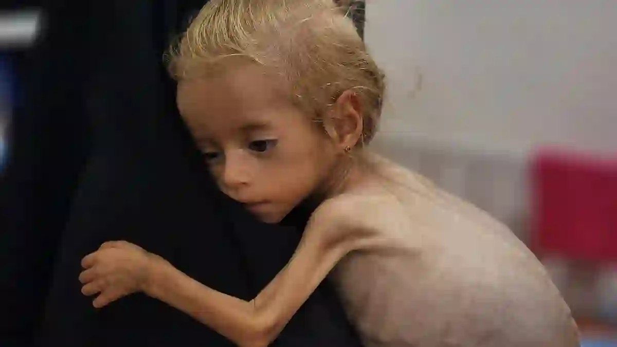 UN-Backed Food Security Body Declares Famine in Gaza City as Half a Million Residents Face Starvation and Malnutrition