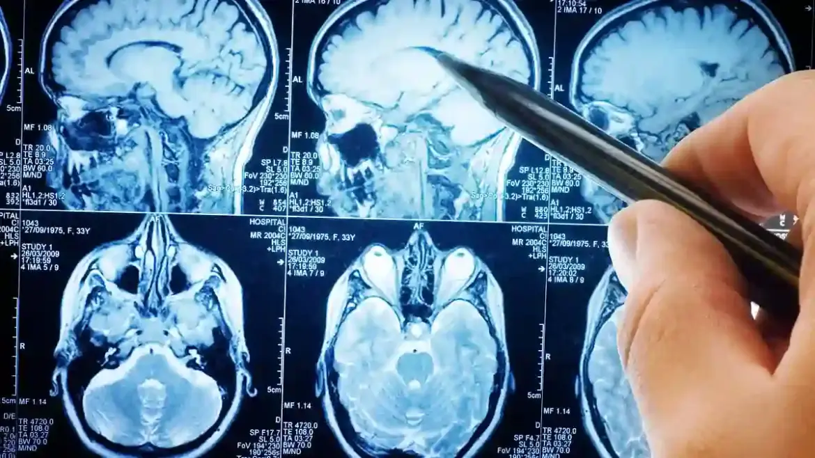 US Researchers Warn That Adults Who Suffer Moderate or Severe Head Injuries Face Increased Risk of Malignant Brain Tumours