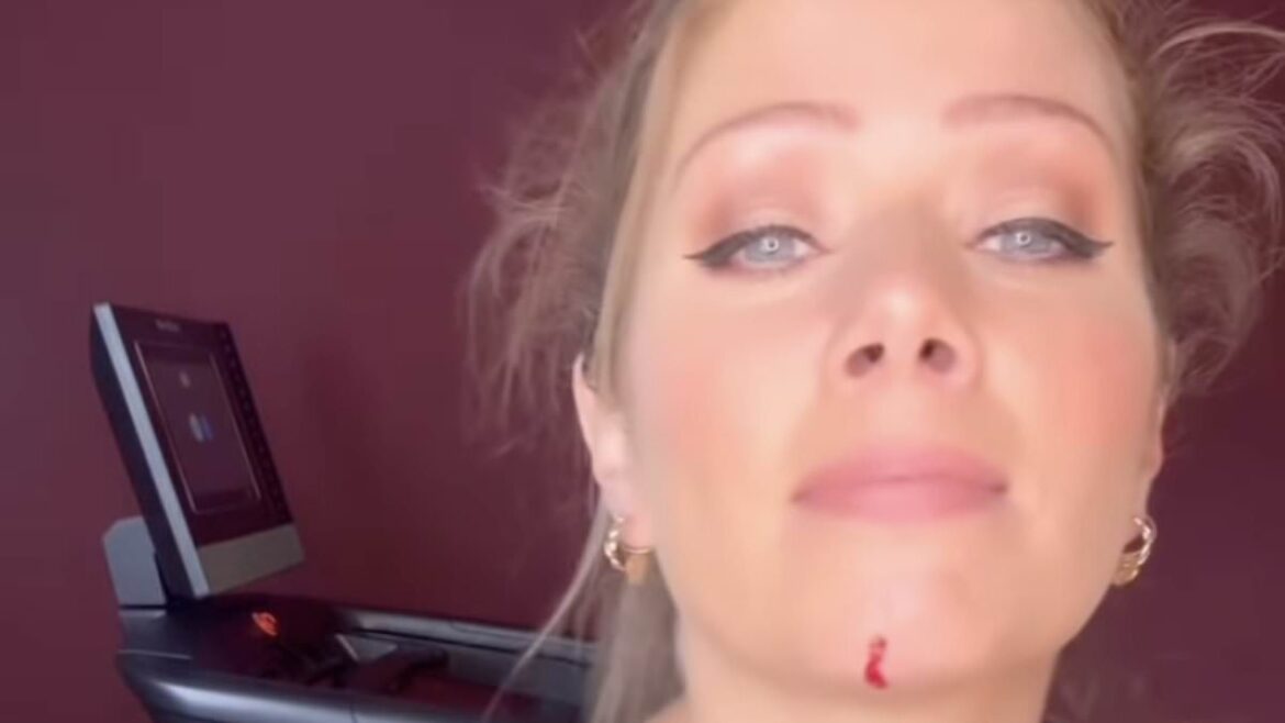 Nikki Sanderson Reveals Horror Treadmill Accident That Injured Her Chin Arms and Knees During Workout at Home in the UK