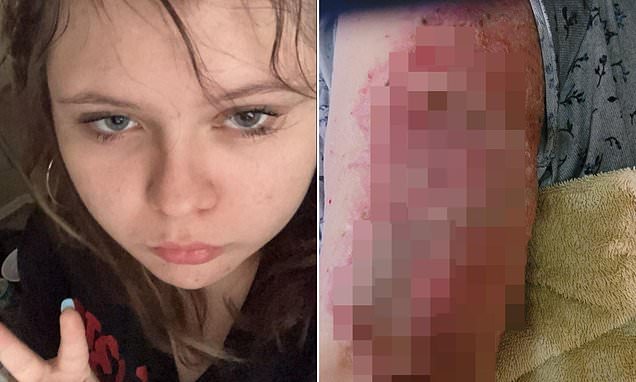 Teen Girl Suffers Extensive Burns and Hospitalization in Phoenix After School District Bus Cuts Force Her to Walk Home in Sweltering Heat
