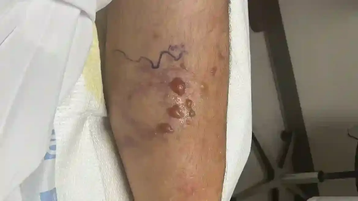Deadly Vibrio vulnificus bacteria spreads through Louisiana waters and claims another life while experts link surge to warming seas
