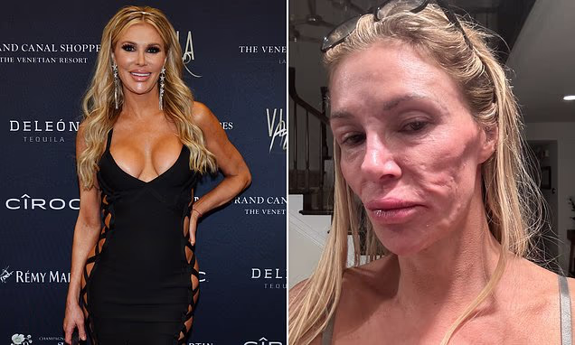 Brandi Glanville reveals the true cause of her facial disfigurement after previously blaming a mysterious parasite during her time in Los Angeles