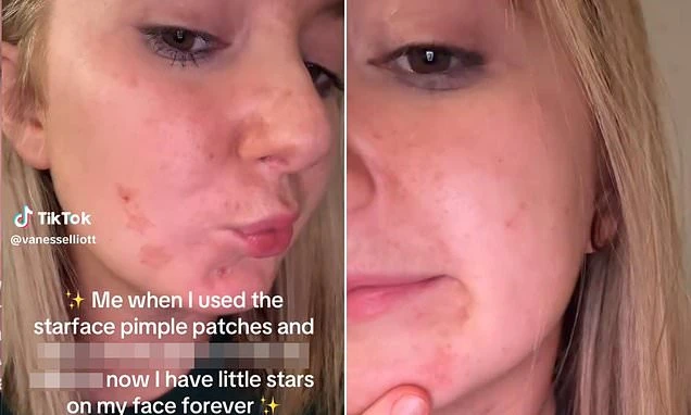 Gen Z skincare enthusiasts experience raised and irritated skin from trendy Starface patches promoted by Nicola Peltz and Cruz Beckham in London and New York