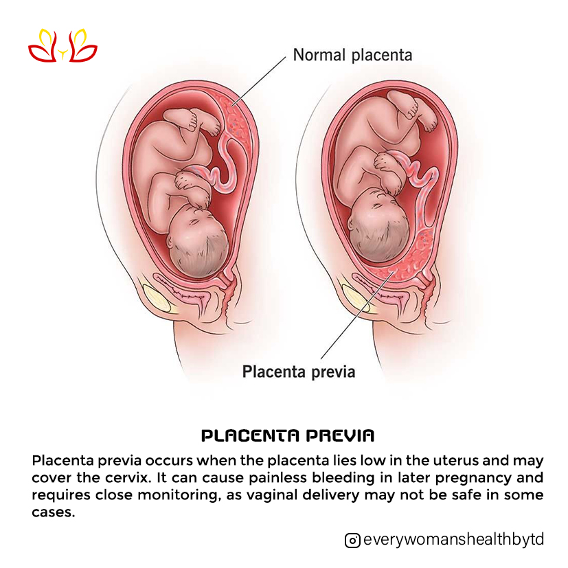 PLACENTA PREVIA 🤰🏽🩸 Placenta previa happens when the placenta lies low in the uterus and partially or completely covers the cervix. 🚨 Why is this important? Because it can cause painless vaginal bleeding in pregnancy, especially in the 2nd or 3rd trimester. 🔎 Types: • Type I – Low-lying placenta • Type II – Marginal • Type III – Partial • Type IV – Complete (covers the cervix fully) ⚠️ Symptoms: • Bright red bleeding • No pain • Bleeding after intercourse sometimes 📌 Risk Factors: • Previous C-section • Multiple pregnancies • Multiple abortions • Advanced maternal age 🩺 Diagnosis: Usually confirmed with ultrasound scan. 💡 Management depends on: • How far gone the pregnancy is • Amount of bleeding • Type of placenta previa 👉 Some cases resolve as pregnancy progresses. 👉 Severe cases may require planned C-section. ❗Important: Any bleeding in pregnancy is NOT normal. Please see your doctor immediately. — #PlacentaPrevia #PregnancyCare #PregnancyEducation #SafeMotherhood #Obstetrics #MaternalHealth #PregnancyJourney #ThirdTrimester #HighRiskPregnancy #WomenHealth #MedEducator #HealthTalkWithTolulope #DrTolulopeSpeaks #NaijaMoms #LagosMoms #PregnancyInNigeria