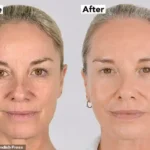 Tamzin Outhwaite Reveals Dramatic NeoGen Facelift Results and Shares Confidence Boost from Non-Surgical Treatment in Finchley