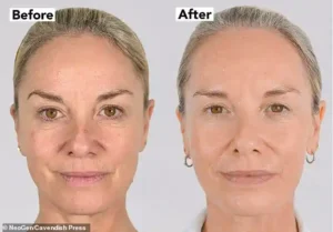 Tamzin Outhwaite Reveals Dramatic NeoGen Facelift Results and Shares Confidence Boost from Non-Surgical Treatment in Finchley