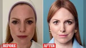 Bethan King discovers Sofwave treatment and lifts drooping eyelids at London clinic