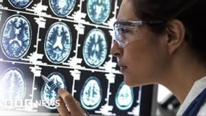 Scientists detect hidden Alzheimer’s brain changes using advanced scans in Lancet studies across United States and Canada research centres
