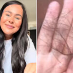 The Dark Side of Weight-Loss Jabs? How Rapid Slimming Left Me With Thinning Hair and Dull Skin