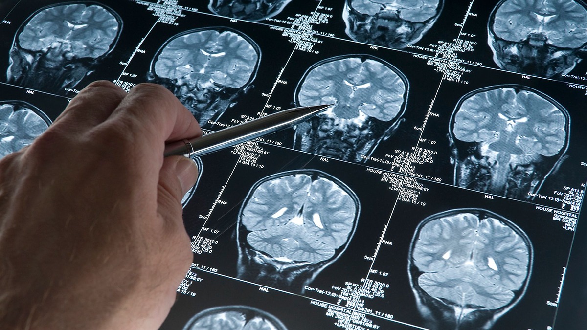 Alzheimer