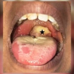 Abuja Watermelon Scare Exposed as FCTA Finds No Evidence of Alleged Diphtheria Case